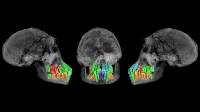 In three views of an ancient hominid skull, the teeth are color coded to show which ones (the green ones) were used in a study to determine the rate of dental development. Other teeth are colored red and orange (for not used in the study) and shades of blue (for missing teeth).